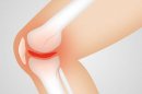 Prinzipien der Arthrose Diät